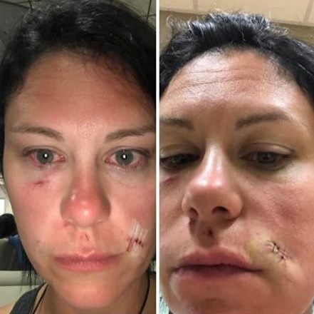 Une femme attaquée par un chien