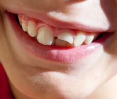 Urgence dentaire : que faire en cas d&rsquo;une dent fracturée